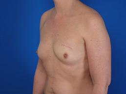 before breast-reconstruction-tissue-expander-macon