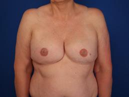 after breast-reconstruction-tissue-expander-macon