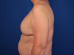 after breast-reconstruction-tissue-expander-macon