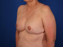 after breast-reconstruction-tissue-expander-macon