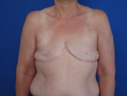 before breast-reconstruction-tissue-expander-macon