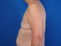 before breast-reconstruction-tissue-expander-macon