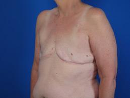 before breast-reconstruction-tissue-expander-macon