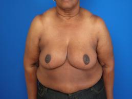 breast-reduction-macon breast-reduction-macon