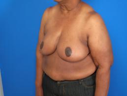 breast-reduction-macon breast-reduction-macon