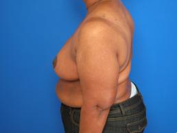 breast-reduction-macon breast-reduction-macon