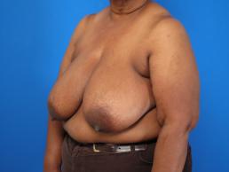 breast-reduction-macon breast-reduction-macon