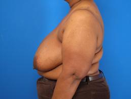 breast-reduction-macon breast-reduction-macon