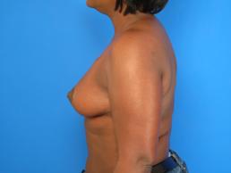breast-reduction-macon breast-reduction-macon