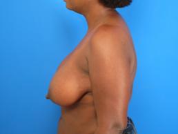 breast-reduction-macon breast-reduction-macon