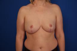 breast-reduction-macon breast-reduction-macon