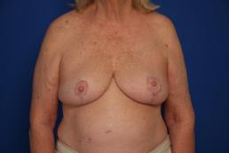 breast-reduction-macon breast-reduction-macon