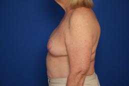 breast-reduction-macon breast-reduction-macon