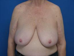 breast-reduction-macon breast-reduction-macon