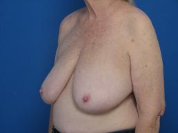 breast-reduction-macon breast-reduction-macon