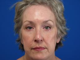 browlift-macon browlift-macon