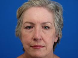browlift-macon browlift-macon