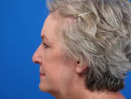 browlift-macon browlift-macon