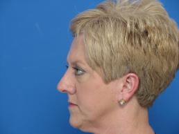 browlift-macon browlift-macon
