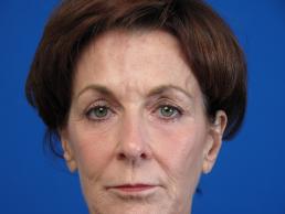 browlift-macon browlift-macon