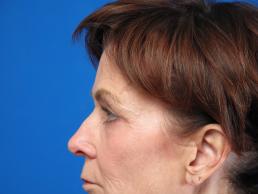 browlift-macon browlift-macon