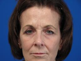 browlift-macon browlift-macon