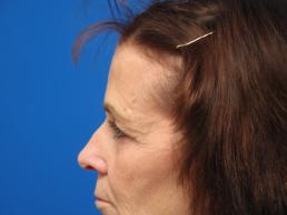 browlift-macon browlift-macon