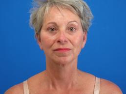 facelifts-macon facelifts-macon