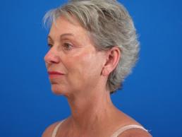 facelifts-macon facelifts-macon