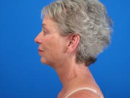 facelifts-macon facelifts-macon