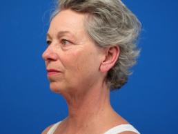 facelifts-macon facelifts-macon