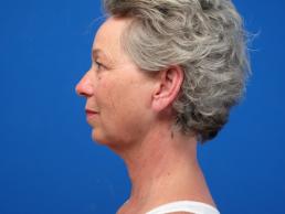 facelifts-macon facelifts-macon