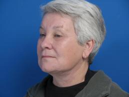 facelifts-macon facelifts-macon