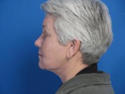 facelifts-macon facelifts-macon