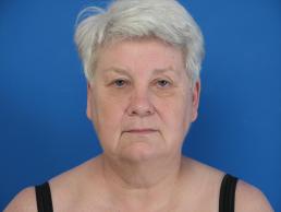 facelifts-macon facelifts-macon