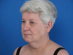 facelifts-macon facelifts-macon