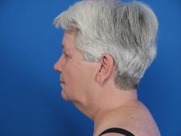 facelifts-macon facelifts-macon