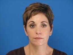 facelifts-macon facelifts-macon