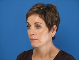 facelifts-macon facelifts-macon
