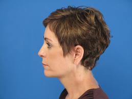 facelifts-macon facelifts-macon