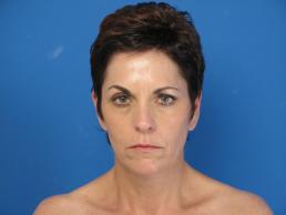 facelifts-macon facelifts-macon