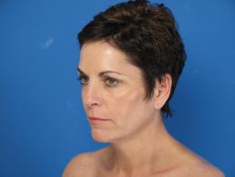 facelifts-macon facelifts-macon
