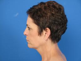 facelifts-macon facelifts-macon