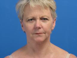 facelifts-macon facelifts-macon