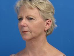 facelifts-macon facelifts-macon
