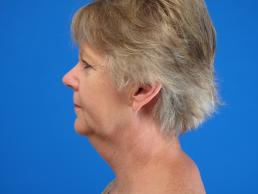 facelifts-macon facelifts-macon