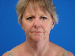 facelifts-macon facelifts-macon