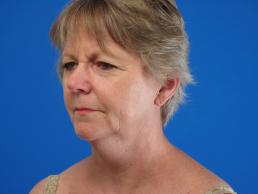facelifts-macon facelifts-macon