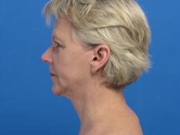 facelifts-macon facelifts-macon
