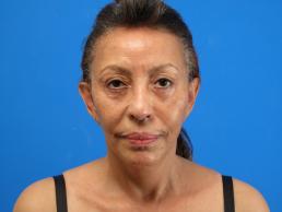 facelifts-macon facelifts-macon